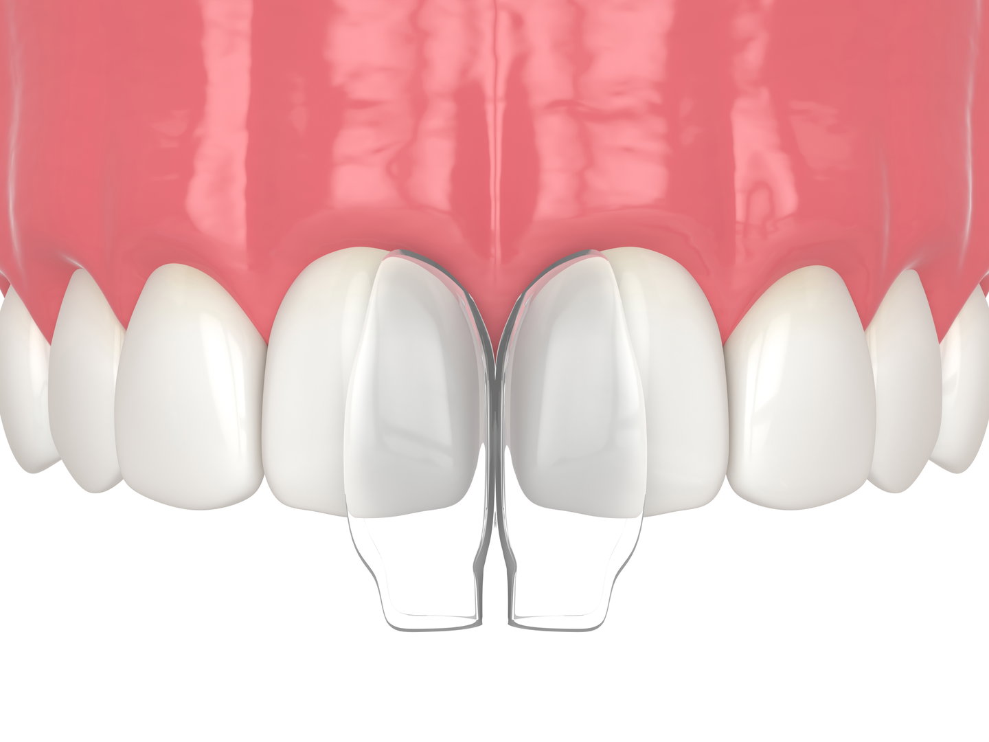 dental-bonding3